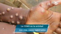 Secretaría de Salud confirma 91 casos de viruela del mono en México