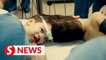 Conjoined twins successfully separated in Brazil