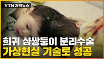 [자막뉴스] '극히 드문 케이스'...희귀 샴쌍둥이 분리수술 기적적 성공 / YTN