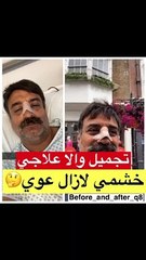خالد أمين يكشف حقيقة خضوعه لعملية تجميل في الأنف