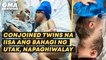 Conjoined twins na iisa ang bahagi ng utak, napaghiwalay | GMA News Feed