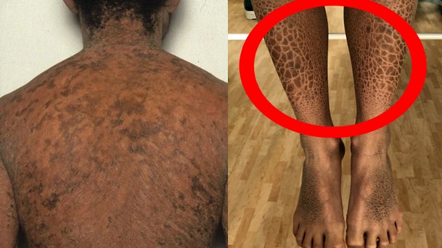 Ichthyosis vulgaris Disease क्या है, Symptoms Reason Treatment । Boldsky *Health