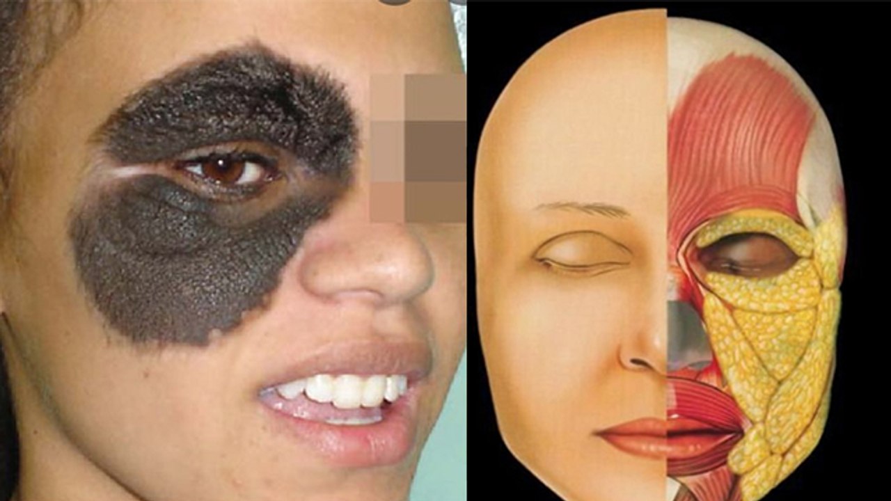 Congenital Melanocytic Nevus क्या है, Face Birthmark से Cancer Risk कितना | Boldsky *Health