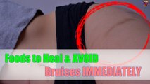 Foods to Heal and AVOID Bruises IMMEDIATELY!