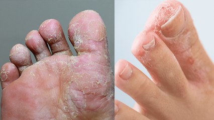 एथलीट फुट क्या है ? Athlete Foot Kya Hai |  Athlete Foot Symptoms | Treatment | Boldsky *Health