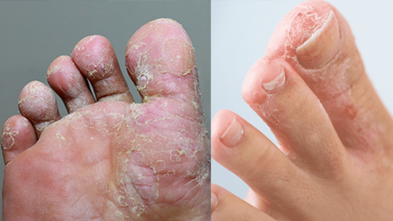 एथलीट फुट क्या है ? Athlete Foot Kya Hai |  Athlete Foot Symptoms | Treatment | Boldsky *Health