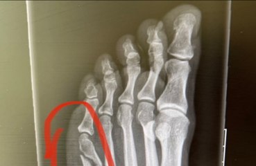 Coleen Rooney shares broken toe X-ray after claims she was ‘milking’ court moon-boot