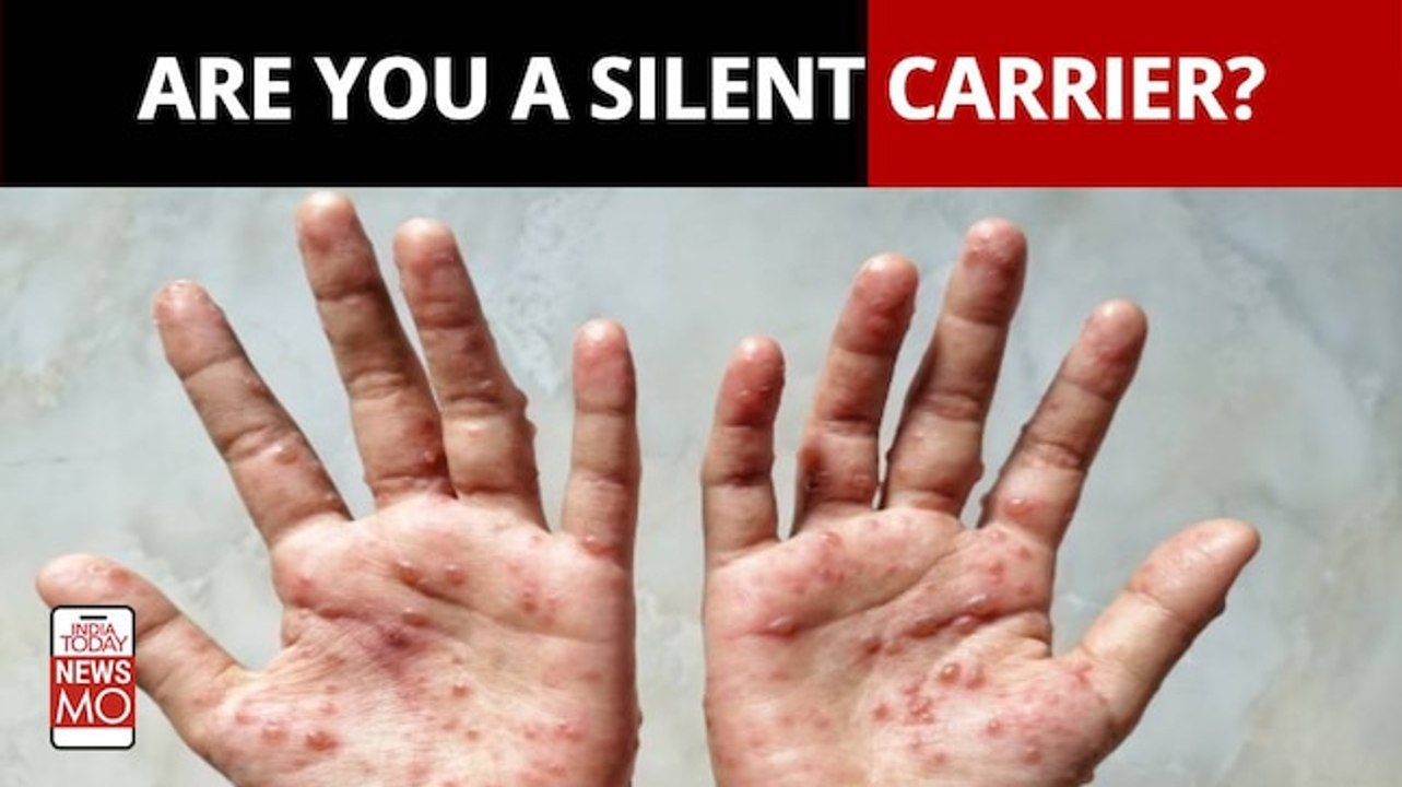 Monkeypox: Should You Watch Out For Asymptomatic Monkeypox?
