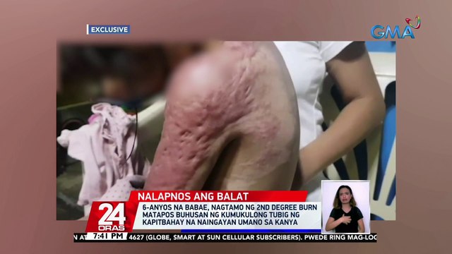 6-anyos na babae, nagtamo ng 2nd degree burn matapos buhusan ng kumukulong tubig ng kapitbahay na naingayan umano sa kanya | 24 Oras