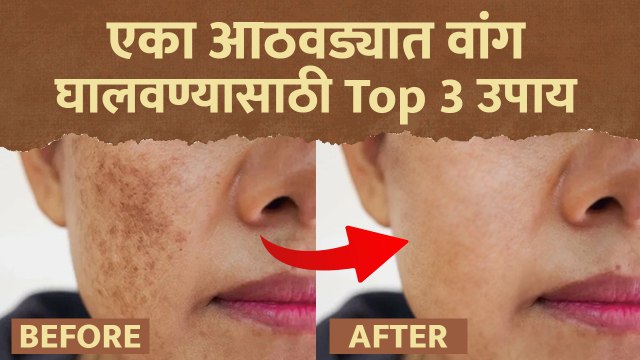 वांग घालवण्यासाठी Top 3 Facepack | How to Get Rid Of Hyperpigmentation | Pigmentation Face Pack