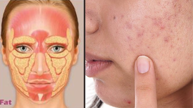 Pimple Kis Vitamin ki kami se hota hai | पिंपल किस विटामिन की कमी से होता है | Boldsky*Health