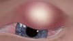 Satisfying, eye style treatment animation - eye pimple - tingle sound [ASMR]