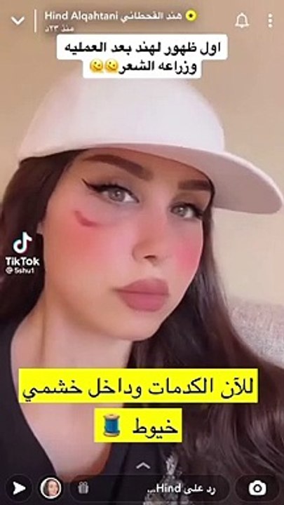 هند القحطاني تصدم المتابعين بشكلها بعد عملية زراعة الشعر