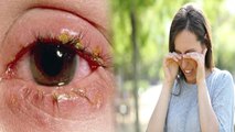 महिलाओं को क्यों होता है Eye Disease Computer Vision Syndrome का ज्यादा खतरा | Boldsky *Health