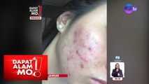 ‘Rosy cheeks’ sa iba, isa pa lang skin condition? | Dapat Alam Mo!