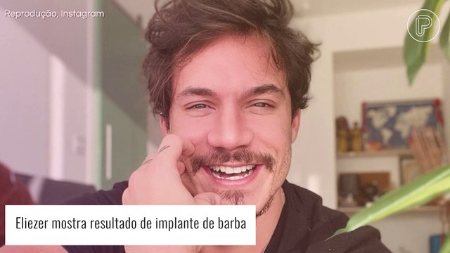 Eliezer mostra antes e depois do implante de barba e é comparado a Luan Santana. Fotos!