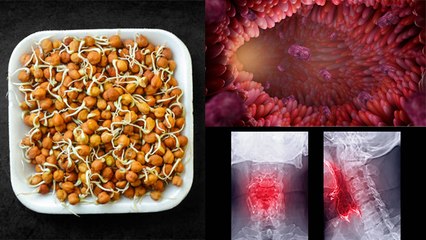 ज्यादा अंकुरित चना खाने से क्या होता है | अंकुरित चना खाने के नुकसान | Boldsky*Entertainment