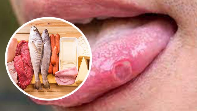 Vitamin B12 Deficiency से क्या होता है। क्या है Vitamin B12 Deficiency Symptoms । Boldsky* Health