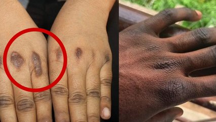 उंगलियों के पोर काले होने की असली वजह | Ungliyo Ke Pore Kale Hone Ki Asli Wajah | Boldsky