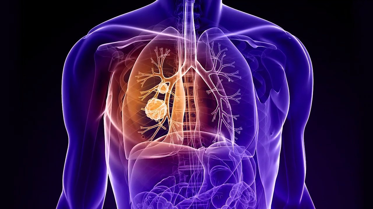 Lung Cancer Symptoms, Causes and Treatment