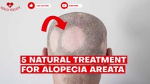 5 Natural treatment for Alopecia Areata (Hairloss / Baldness) you can try at home