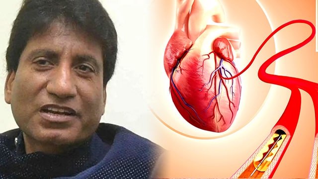 Raju Shrivastav की हुई Angioplasty Kya Hai | एंजियोप्लास्टी कैसे होती है | Boldsky *Health