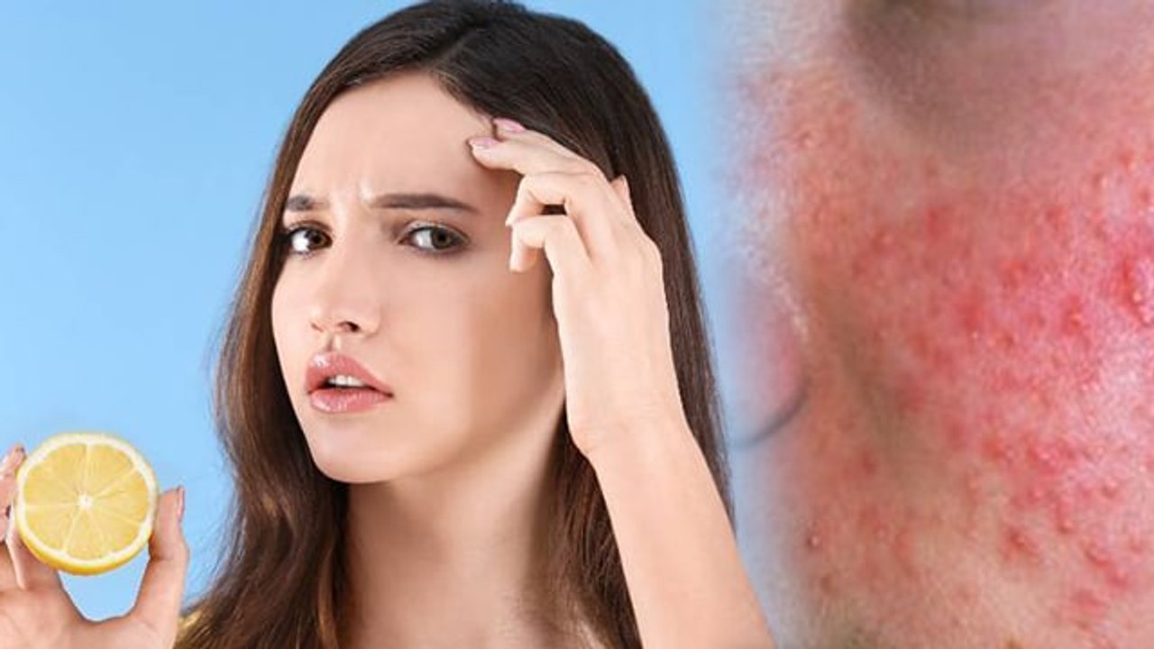 चेहरे पर नींबू लगाने के गंभीर नुकसान । Chehre par Nimbu Lagane ke Gambhir Nuksan । Boldsky* Health