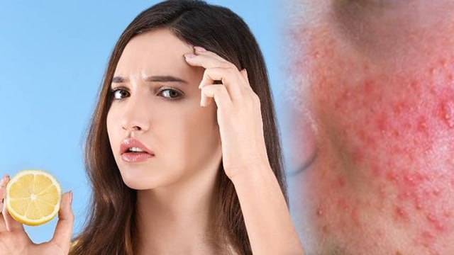चेहरे पर नींबू लगाने के गंभीर नुकसान । Chehre par Nimbu Lagane ke Gambhir Nuksan । Boldsky* Health