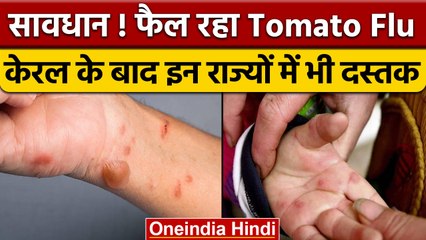 Tomato Flu: अब Haryana-Tamil Nadu और Odisha में टोमैटो फ्लू की दस्तक | वनइंडिया हिंदी | *News