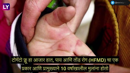 Tomato Flu ने वाढवली चिंता, केंद्राने राज्यांना दिला सतर्कतेचा इशारा