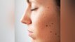 चेहरे से तिल हटाने के लिए घरेलू उपाय | Home Remedy to Remove Moles | Boldsky *Health