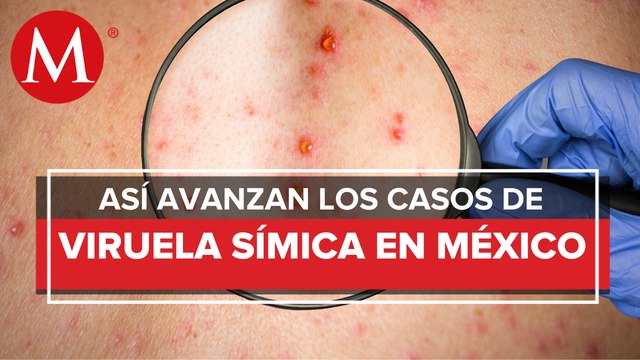 Casos de viruela del mono en México suben 70% en una semana; hay 252 en 20 estados