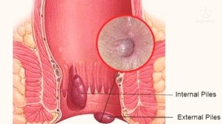 what is piles/ hemorrhoid's . Its causes, symptoms and treatment
