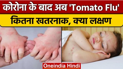 Tomato Flu ने बढ़ाई Doctors की चिंता, Monkeypox से है ज्यादा ख़तरनाक | वनइंडिया हिंदी |*News