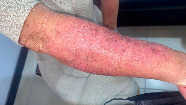 bd-alergias-frecuentes-en-adulto-mayor-causas-y-tratamientos-190822