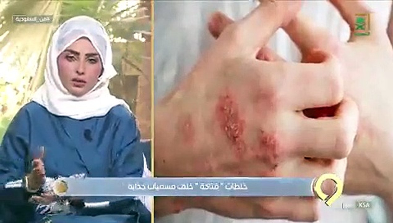 استشارية: مواد التبييض السريع ادعاءات «كاذبة» ولها آثار سلبية على البشرة