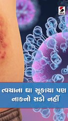 જર્મનીમાં મળ્યો મંકીપોક્સનો ખતરનાક કેસ