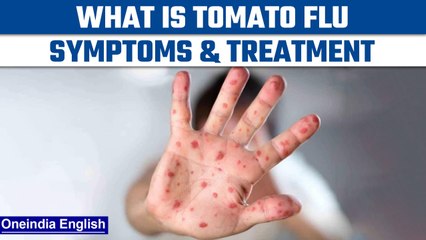 Tomato Flu cases rise to 82 in India | Know all about Tomato Flu | Oneindia News *News