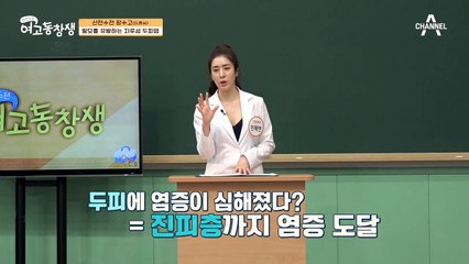 두피의 염증이 나면서 모근이 약해지는 지루성 두피염, 탈모를 유발한다?