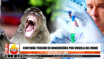 Continúa tensión en hondureños por viruela del mono