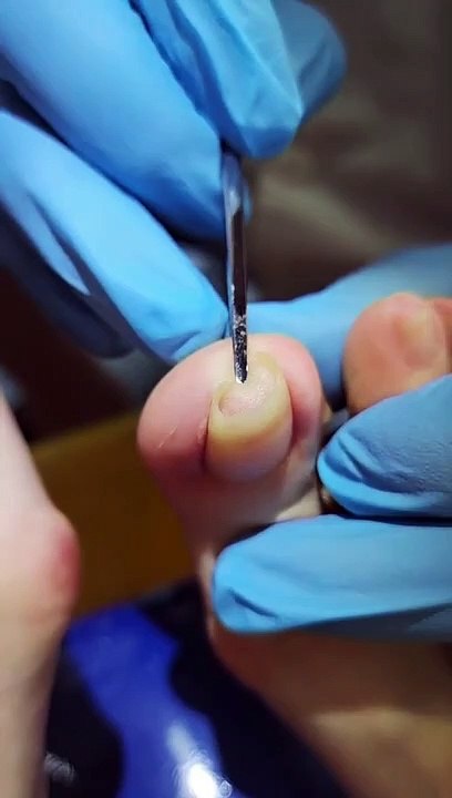 #shorts Top Abnehmen & Schneiden Alte & Lange Große Eingewachsene Zehennägel Art Toenail Roomb