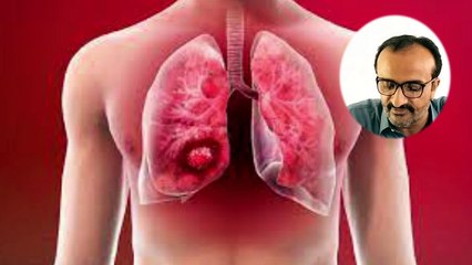 Lungs Cancer