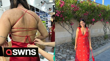 Woman shocked her 'eczema' was a fungal infection after a stranger on TikTok to get it checked out