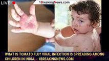 What is tomato flu? Viral infection is spreading among children in India. - 1breakingnews.com