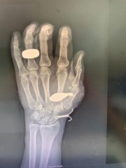 BÜYÜKÇEKMECE'DE SIKIŞAN OLTAYI ÇEKERKEN BALIK KURŞUNU EL KEMİĞİNE SAPLANDI