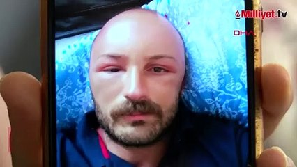 2 gün plaja gitti, başında nadir görülen sıcak ödemi oluştu