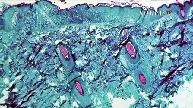 Hoaks Cacar Monyet Menyebar Lewat Udara - NEWS OR HOAX