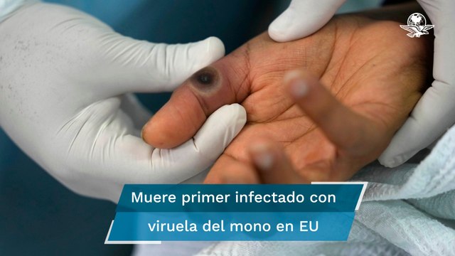 Registran primera muerte en Estados Unidos por viruela del mono