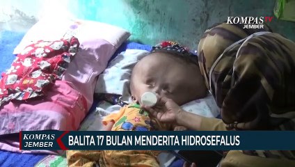 Balita Menderita Hidrosefalus, Belum Pernah Tersentuh Pengobatan Medis