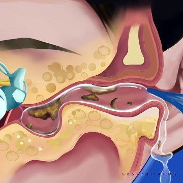 ear cleaning ASMR-Water Device Removes Earwax- Ear cleaning animation